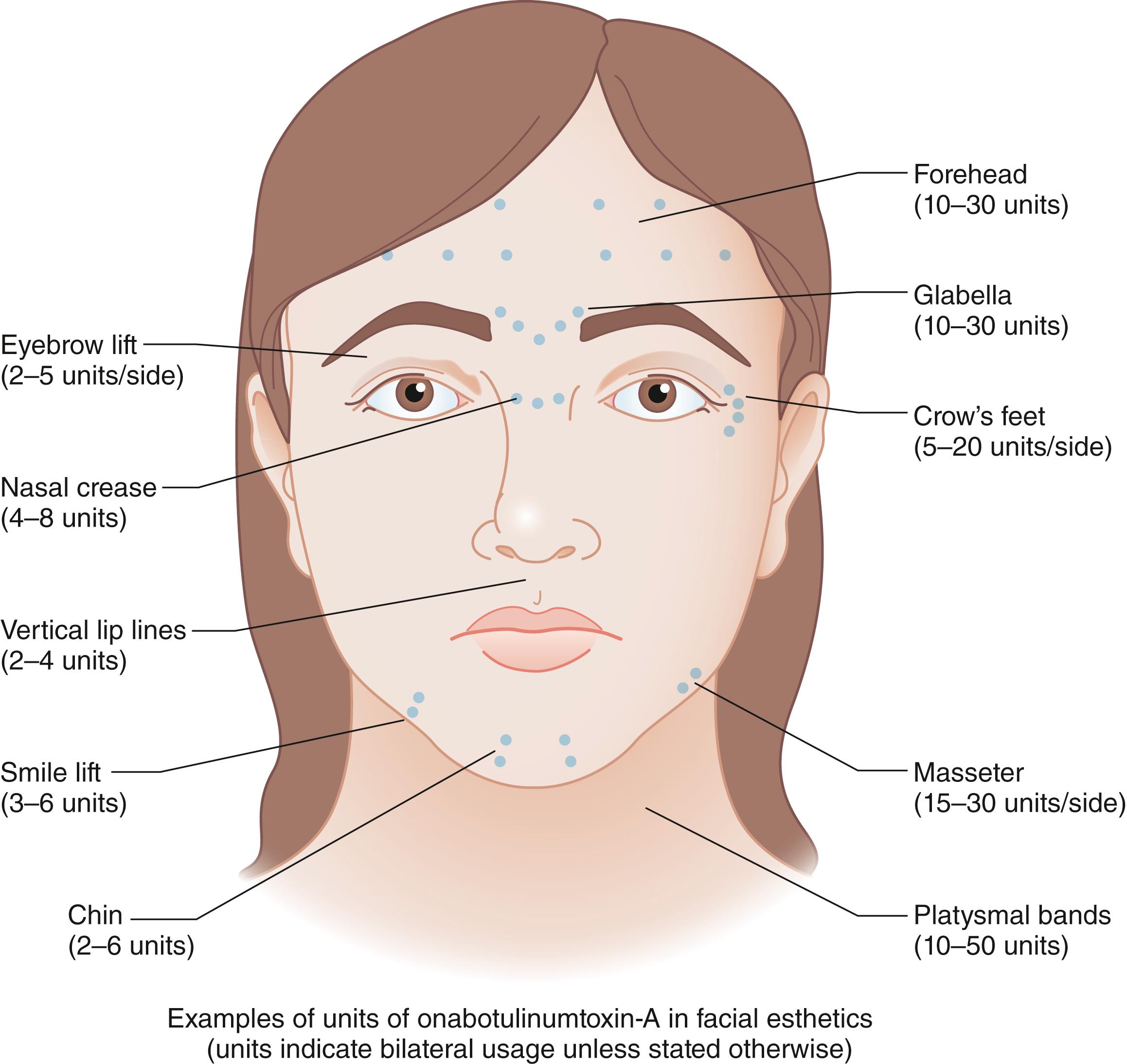 Fig. 61.1, Suggested map and dosage for injection of onabotulinumtoxin-A.