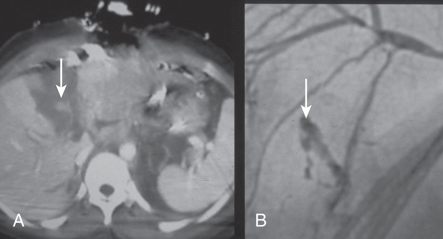 FIGURE 2, (A) Abdominal CT scan demonstrating intraparenchymal liver laceration (grade III) with an area of contrast extravasation or “blush” (arrow) . (B) Hepatic angiogram of the same injury demonstrating contrast extravasation from the right hepatic arterial system (arrow) .