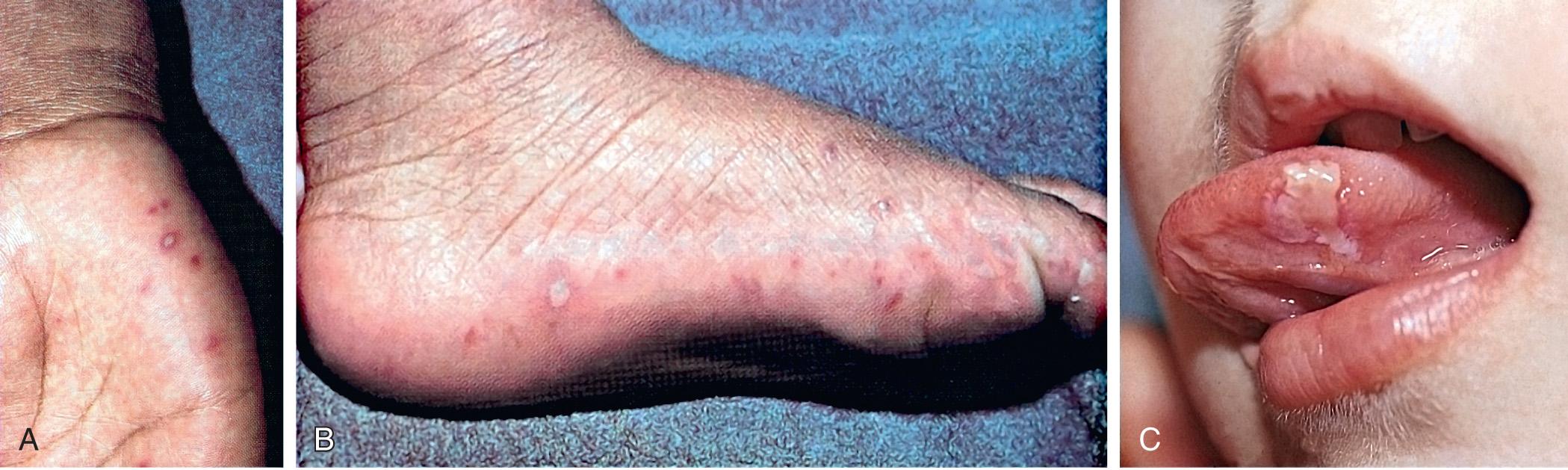 Fig. 277.1, A, Oval blisters of the palms in a child with hand-foot-and-mouth disease (coxsackievirus A16 infection). B, Oval blisters on the feet of a child with hand-foot-and-mouth disease. C, Erosion of the tongue in a child with hand-foot-and-mouth disease.