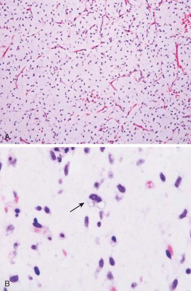 Figure 60-2, Myxoid liposarcoma.