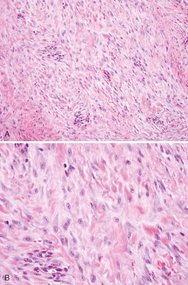 Figure 60-3, Desmoid tumor.