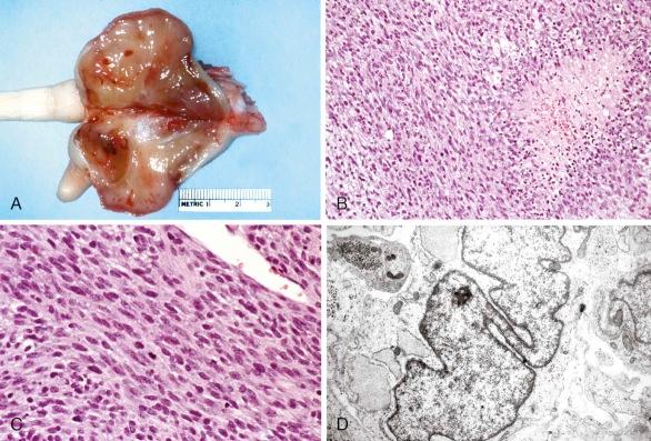 Figure 60-5, Infantile fibrosarcoma.