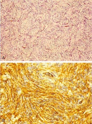 Figure 60-6, Dermatofibrosarcoma protuberans.