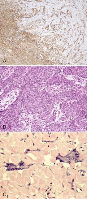 Figure 60-7, Fibrosarcoma in dermatofibrosarcoma protuberans/giant cell fibroblastoma.