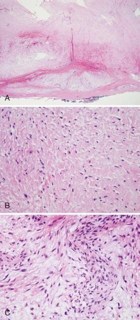 Figure 60-9, Low-grade fibromyxoid sarcoma.