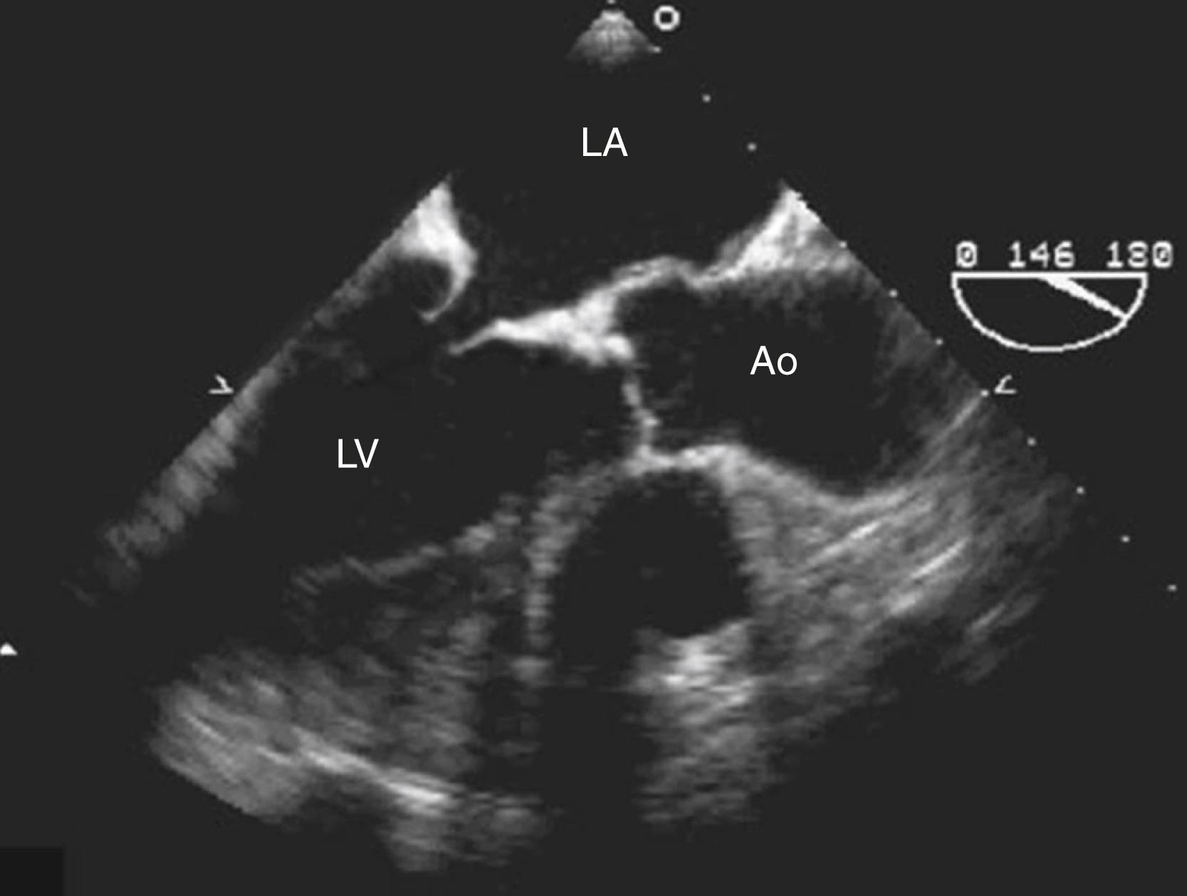 Figure 92.1, Transesophageal echocardiography from a 78-year-old woman with mild mitral stenosis caused by mitral annular and leaflet calcification that illustrates differences from rheumatic mitral stenosis. Calcification is present in the basal portion of both leaflets and spares the free edges (tips) of the leaflets. There is also lack of commissural fusion (not shown in this view). Ao, Ascending aorta; LA, left atrium; LV, left ventricle.