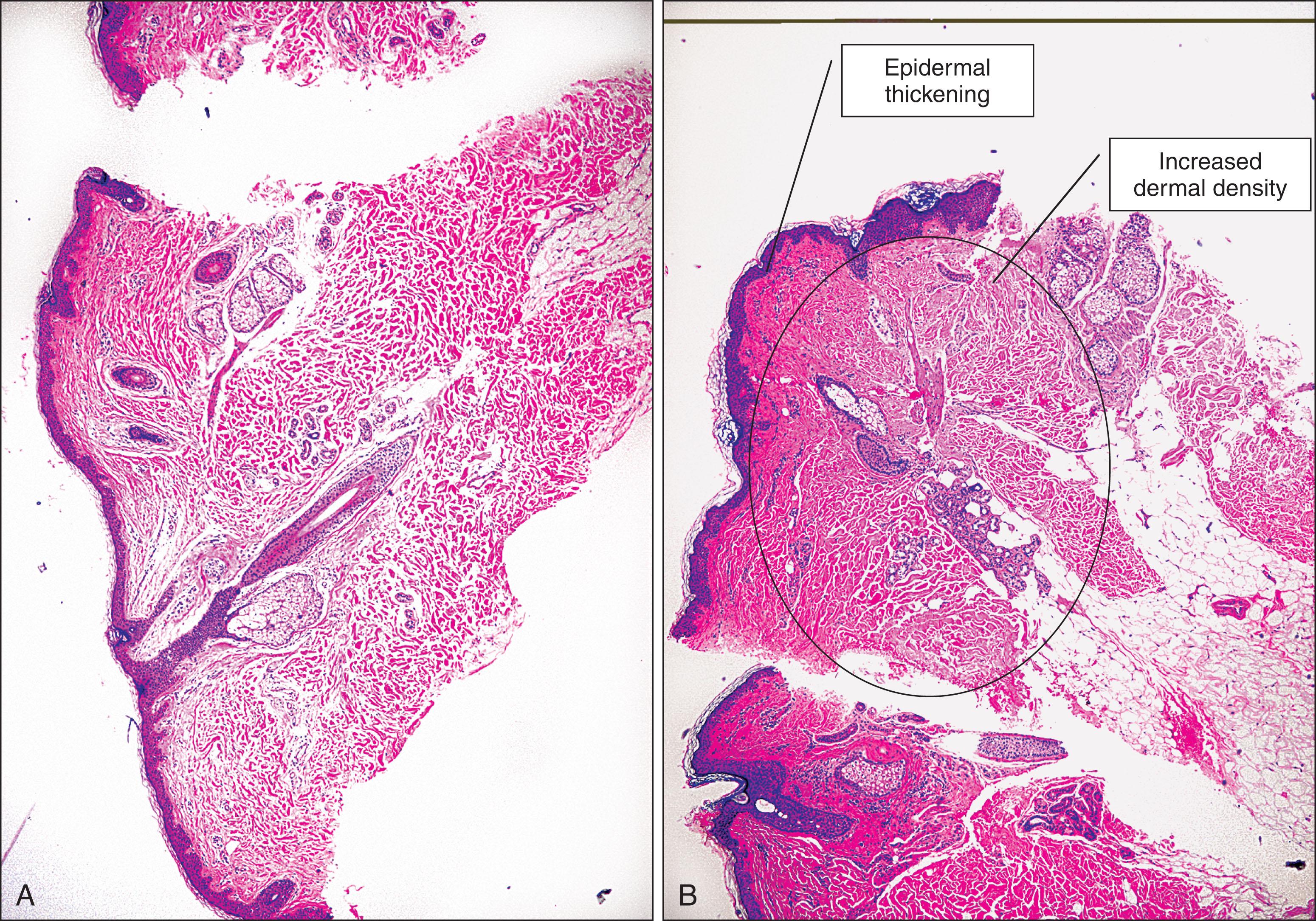 Fig. 7.1, Human skin (A) before and (B) 4 months after treatment with Thermage, showing epidermal thickening and increased dermal density.