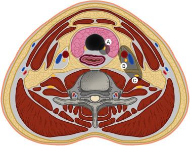 Fig. 51.1, Cross section of the neck at the level of mid-thyroid gland. A, Recurrent laryngeal nerve; B, vagus nerve; C, sympathetic ganglia.