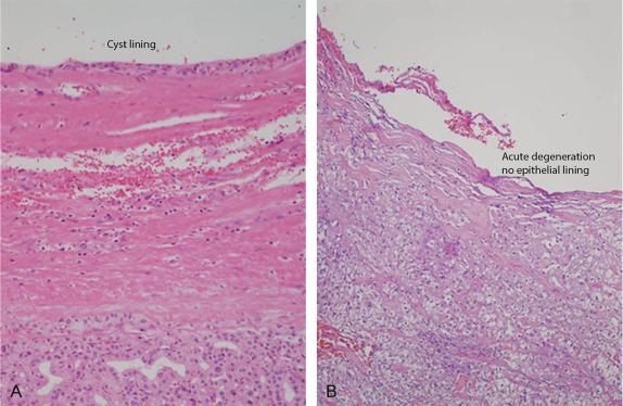 Fig. 51.2, A, Cyst. B, Pseudocyst.