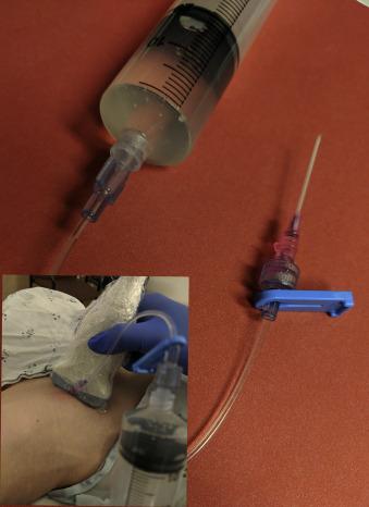 Fig. 51.4, Cyst aspiration using intravenous (IV) cannula and extension tube.