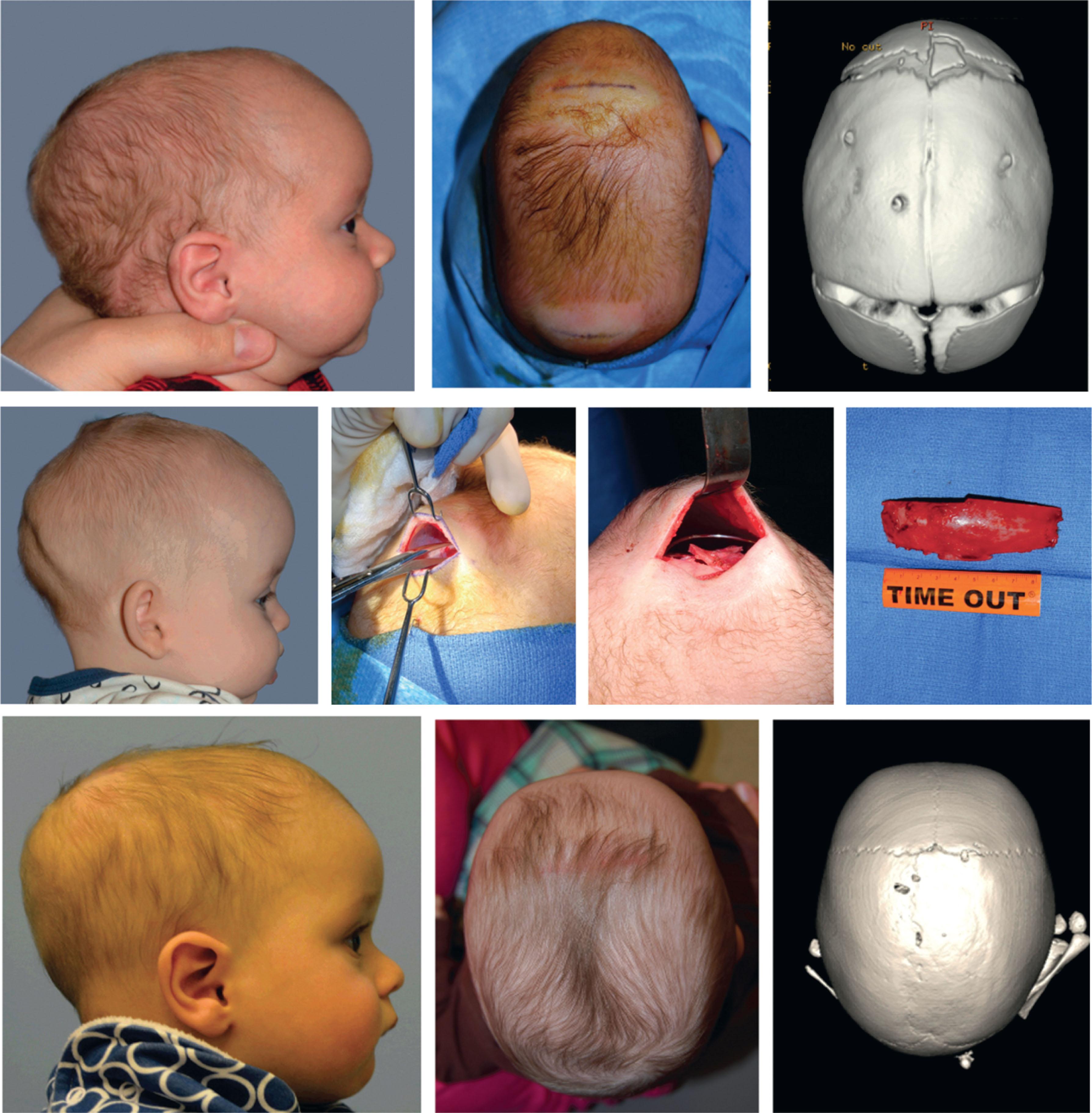 Figure 25.2.1, Spring-mediated cranioplasty. 3.5-month-old male presenting with characteristic scaphocephaly consistent with sagittal craniosynostosis ( top ). Through two ~4-cm incisions near bregma and lambda, the synostotic suture is removed, two (or three) cranial springs are placed, and the removed bone morselized and replaced across the suturectomy site. Lifting of the parietal plates across the coronal and lambdoid sutures confirms appropriate spring expansion during the early postoperative period ( middle ). 6-months postoperatively, the patient demonstrates a normocephalic head shape.