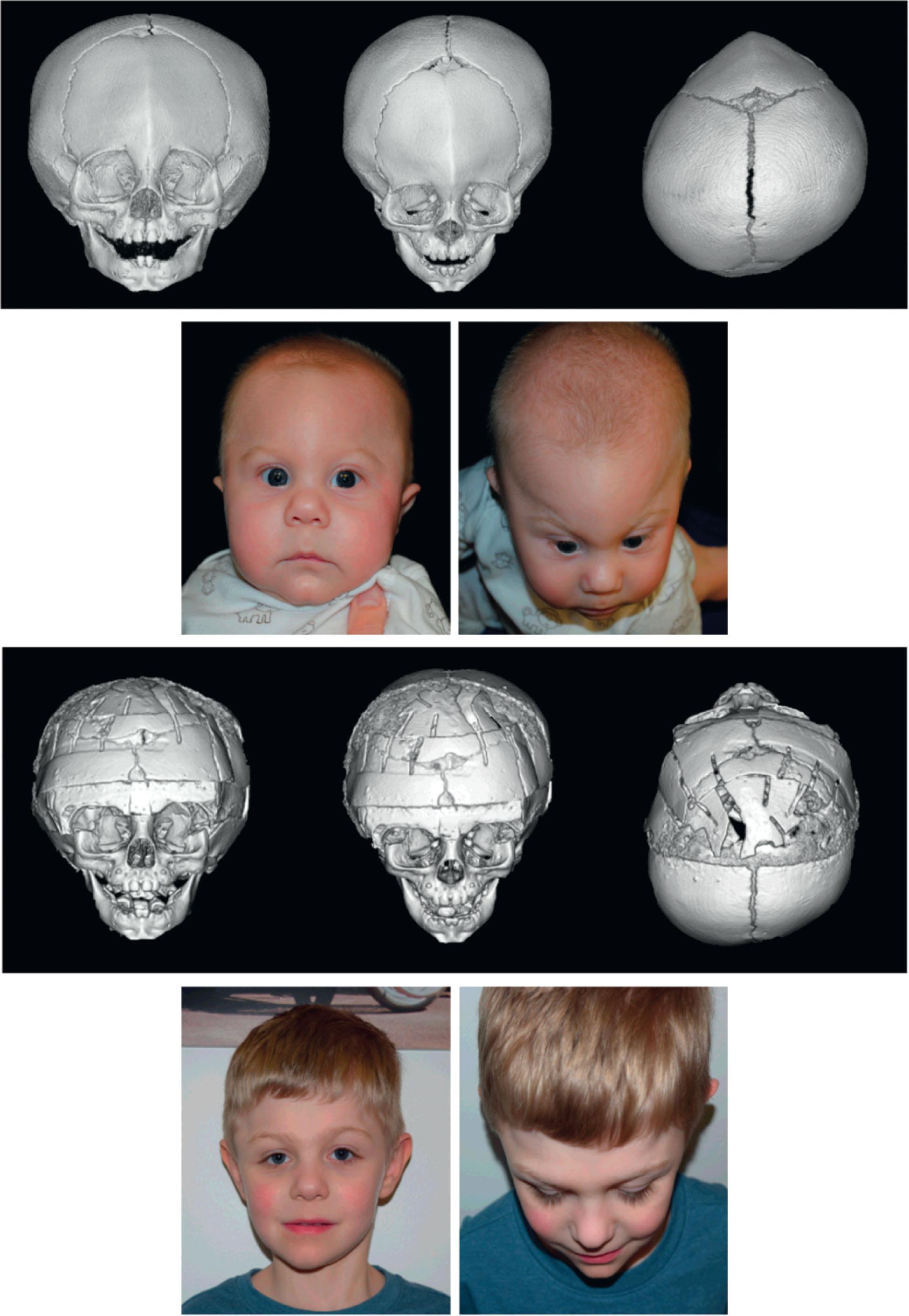 Figure 25.2.2, Bifrontal orbital advancement and remodeling in severe trigonocephaly. 5-month-old male presenting with imaging confirmed metopic craniosynostosis with sutural ridging, upsloping superior orbital rims, orbital narrowing, and interorbital narrowing ( panel 1 ). On bird’s eye view, he demonstrates severe trigonocephaly with hypotelorism ( panel 2 ). He underwent BFOAR at 9 months with a reinforced, interpositional bone graft to the central bandeau to expand the outer orbital distance to ~90 mm in an overcorrected position ( panel 3 ). Several years later, he demonstrates a more normalized forehead contour with slight orbital asymmetry ( panel 4 ).