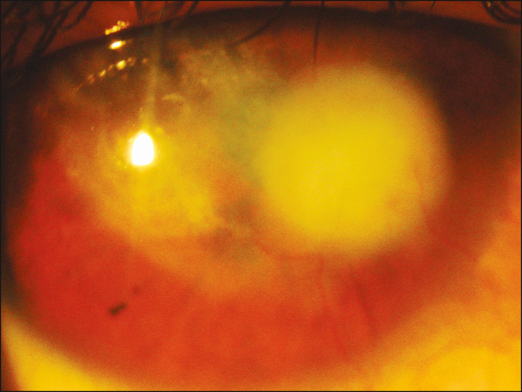 Fig. 85.1, Late stage of tuberculosis interstitial keratitis with marked corneal scarring and loss of transparency, compromising best corrected visual acuity.