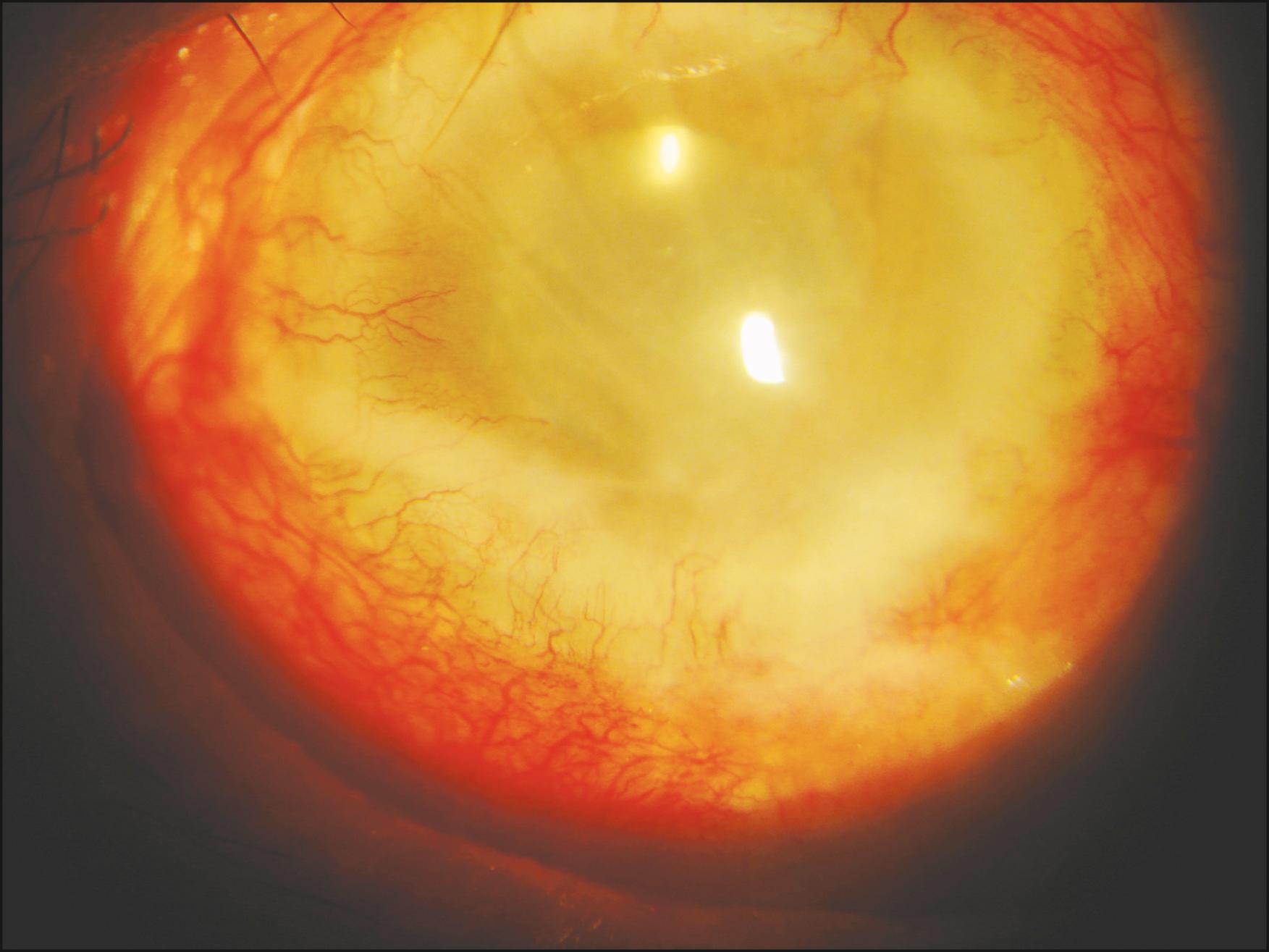 Fig. 85.2, Vascularization and corneal opacification as a late sequel of interstitial keratitis in Hansen disease.