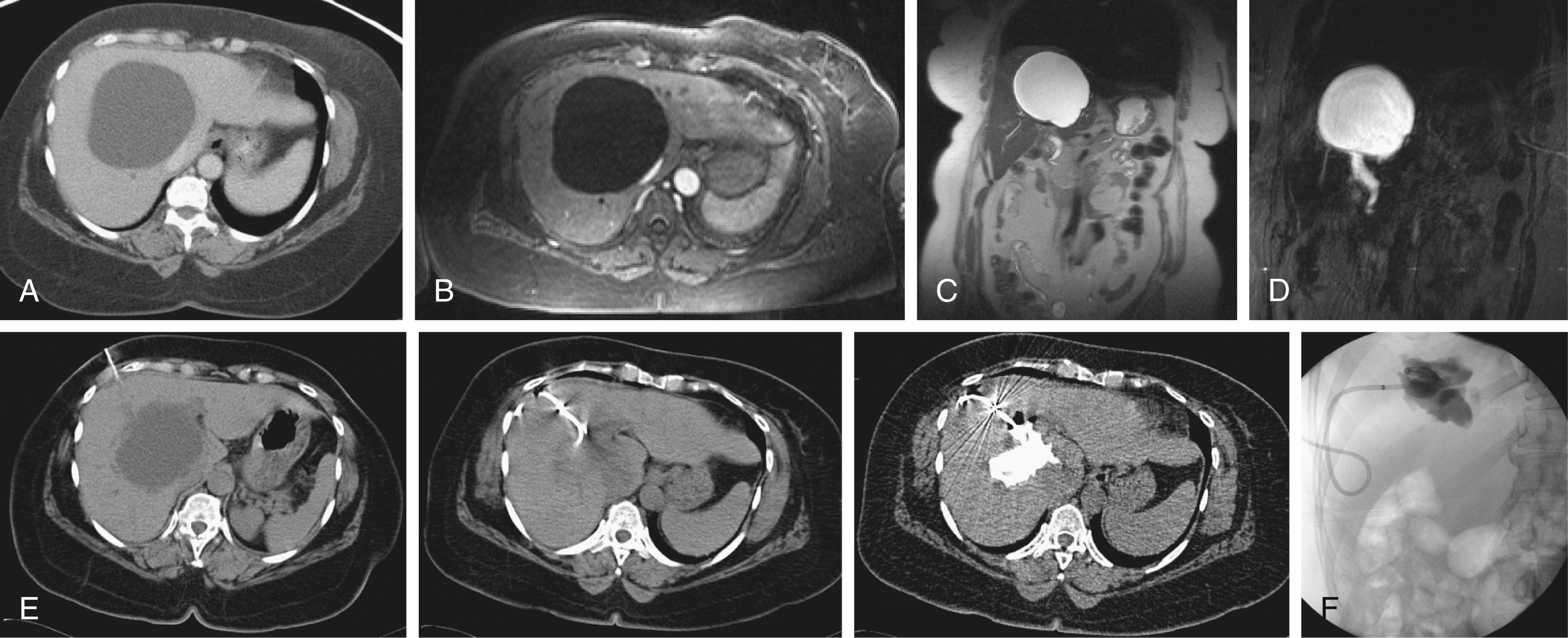 Fig. e99.1, Noncontrast computed tomography (CT) of a 57-year-old woman with biliary obstruction due to a large hepatic cyst. (A) Cyst measures as simple fluid in attenuation. (B) Magnetic resonance three-dimensional volumetric interpolated breath-hold examination postcontrast sequence demonstrates no internal or peripheral cyst enhancement, compatible with simple cyst. Coronal magnetic resonance cholangiopancreatography ([C]) and half-Fourier acquisition single-shot turbo spin-echo ([D]) sequences demonstrate right hepatic lobe biliary dilation distal to cyst. (E) Cyst was successfully drained under CT guidance (three images). (F) Before removal after sclerosis, a cytogram was performed, demonstrating marked decrease in cavity size.