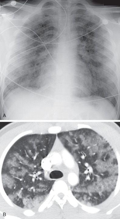 Fig. 52.1, Mild fat embolism after motor vehicle accident: radiographic and CT findings. (A) Anteroposterior chest radiograph 2 days after motor vehicle collision shows peripheral predominant consolidation. (B) Axial CT demonstrates patchy bilateral ground-glass opacities with well-defined lobular sparing.