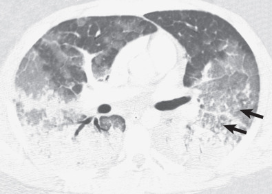 Fig. 52.2, Fat embolism after hip arthroplasty: CT findings. Axial CT demonstrates extensive bilateral consolidation, ground-glass opacities, lobular sparing, and a few poorly defined centrilobular nodules (arrows). The consolidation and ground-glass opacities have a dependent distribution.