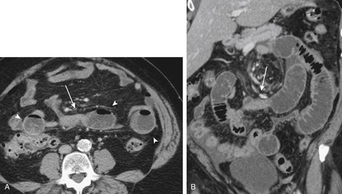 FIGURE 9-1, A 76-year-old woman with mechanical small bowel obstruction. Axial (A) and coronal (B) portal venous phase computed tomography images demonstrate multiple dilated loops of small bowel ( arrowheads , A ) with rapid transition from dilated loops to more normal appearing, collapsed loops (arrows) identified as a result of postsurgical adhesions on operative repair.