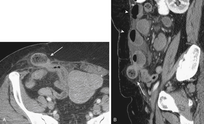 FIGURE 9-2, A 32-year-old woman with an incarcerated incisional hernia. Axial (A) and sagittal (B) portal venous phase images demonstrate an incarcerated loop of small bowel (arrows) demonstrating fecalization with proximally obstructed loops of small bowel identified ( arrowheads , B ).