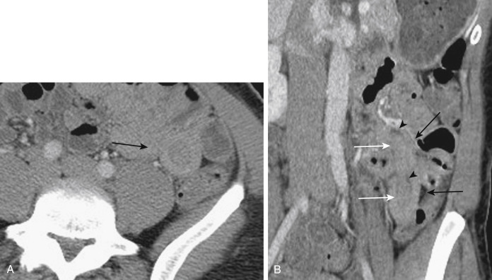 FIGURE 9-3, A 30-year-old woman with transient intussusception. An axial portal venous phase image (A) reveals the presence of a small bowel intussusception (arrow) . A coronal image (B) clearly shows the intussusceptum (white arrows) within the receiving loop of small bowel and the intussuscipiens (black arrows) , surrounded by small amounts of mesenteric fat (arrowheads) .