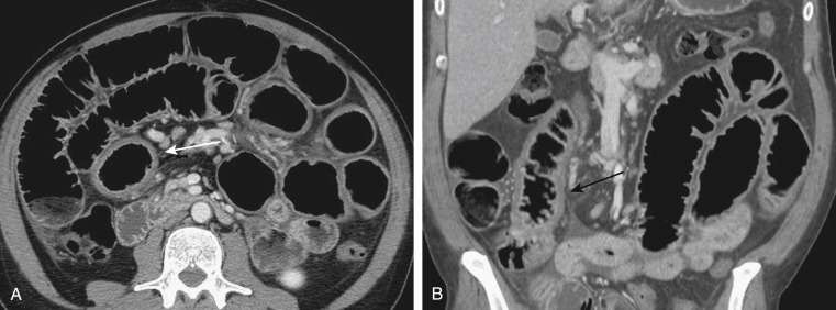 FIGURE 9-4, A 40-year-old man with viral gastroenteritis. Axial (A) and coronal (B) portal venous phase computed tomography images reveal diffuse small bowel dilatation, as well as mural thickening (arrows) .