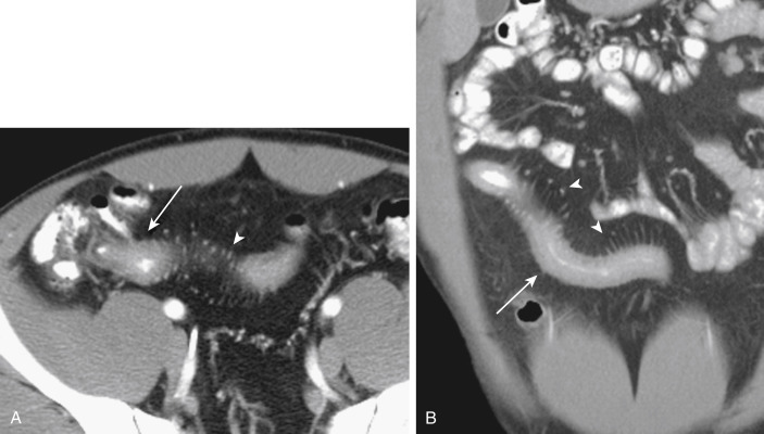 FIGURE 9-5, A 24-year-old man with Crohn disease. Axial (A) and coronal (B) portal venous phase computed tomography images demonstrate thickening of the terminal ileum (arrows) with prominence of the vasa recta along the mesenteric border (arrowheads) , the so-called “comb” sign.