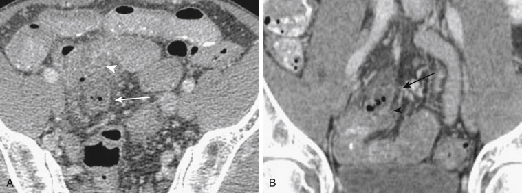 FIGURE 9-6, A 38-year-old man with Meckel diverticulitis. Axial (A) and coronal (B) portal venous phase images reveal a tubular, blind-ending pouch (arrows) emanating from adjacent small bowel (arrowheads) with surrounding inflammatory changes—findings consistent with Meckel diverticulitis.