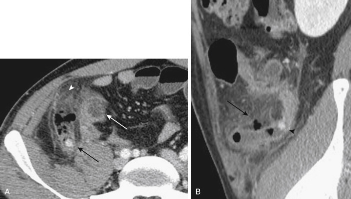 FIGURE 9-7, A 46-year-old man with a perforated appendicitis. An axial portal venous phase computed tomography (CT) image (A) demonstrates an inflamed appendix with periappendiceal fat stranding (arrowhead) and phlegmon (white arrow) , as well as an appendicolith at the appendiceal base (black arrow) . A sagittal portal venous phase CT image (B) demonstrates extraluminal air (black arrow) consistent with perforation, as well as the appendicolith (arrowhead) .