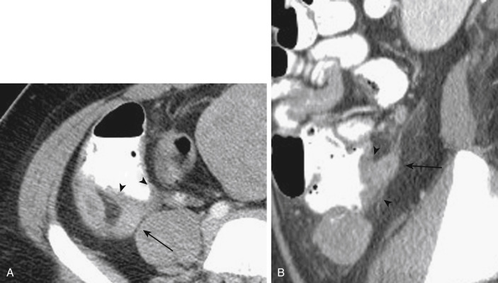 FIGURE 9-8, A 20-year-old woman with appendicitis. Axial (A) and sagittal (B) portal venous phase computed tomography images demonstrate a dilated appendix consistent with appendicitis (arrows) . Although not necessary in this case given the significant appendiceal dilatation, secondary signs of adjacent cecal wall thickening ( arrowheads , B ), the so-called “arrowhead” sign, may be useful in equivocal cases.