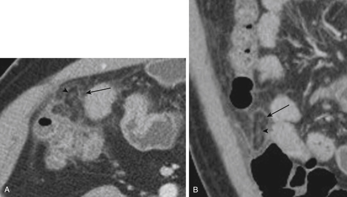 FIGURE 9-9, A 42-year-old man with epiploic appendagitis. Axial (A) and coronal (B) portal venous phase computed tomography images demonstrate a pericolonic, ovoid, fat-containing lesion (arrows) with a central high-attenuation focus (arrowheads) consistent with epiploic appendagitis.