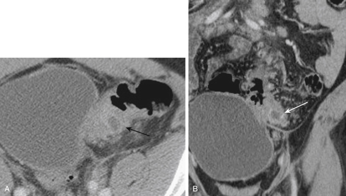 FIGURE 9-10, A 50-year-old man with diverticulitis. Axial (A) and coronal (B) portal venous phase computed tomography images reveal thickening of the sigmoid colon with a central low-attenuation focus consistent with an intramural abscess (arrows) .