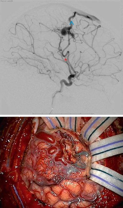 Figure 14.1, Lateral projection of a digital subtraction angiogram with injection of the internal carotid artery shows a small AVM with a primary feeding artery from the middle cerebral artery (*), followed by the nidus and then a large cortical draining vein (^). The right image is an intraoperative photograph of a resection of an AVM demonstrating engorged cortical AVM vessels and highlighting the technique of interrupting arterial feeders before cutting venous drainage.