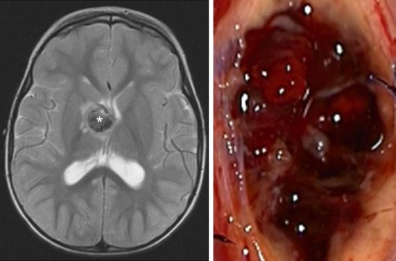 Figure 14.2, An axial T2 MRI shows a hemorrhagic cavernous malformation near the foramen of Monro (*). To the right, an intraoperative photo demonstrates the characteristic “mulberry” lobulated appearance of the cavernous malformation.