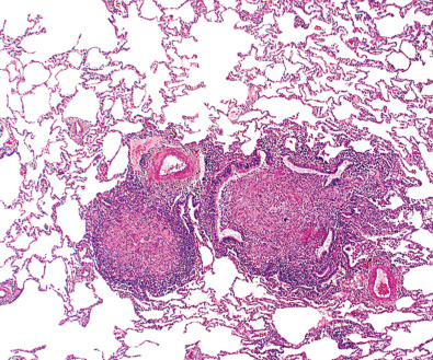 Fig. 11.1, Peribronchial granulomas. A low-power photomicrograph of a lung biopsy specimen shows granulomas centered on a bronchovascular bundle in a patient with Mycobacterium avium-intracellulare infection. The granuloma on the right occupies and is occluding the bronchiolar lumen.