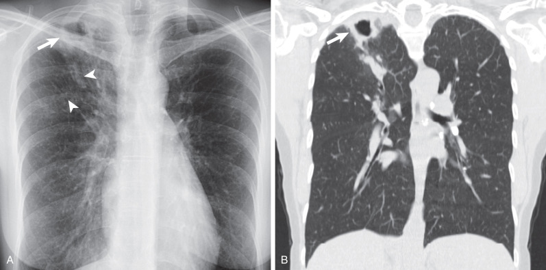 Fig. 11.2, Nontuberculous mycobacteria (NTMB) infection in chronic obstructive pulmonary disease (COPD). A chest radiograph (A) and coronal noncontrast CT scan (B) show hyperinflated lung volumes with a cavitary right upper lobe nodule (arrows) with adjacent nodular opacities (arrowheads). This appearance represents reactivation tuberculosis infection until proven otherwise. NTMB infection may appear similar and is most common in alcoholic patients or in those with COPD.
