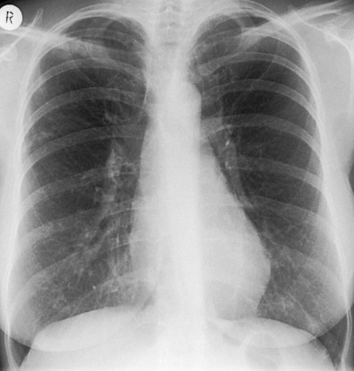 Fig. 11.3, Radiographic findings of Mycobacterium avium-intracellulare infection. A chest radiograph shows subtle nodular shadowing in the periphery of the right upper lobe caused by M. avium-intracellulare. A chest radiograph obtained 9 months later showed resolution (the patient was not undergoing treatment).