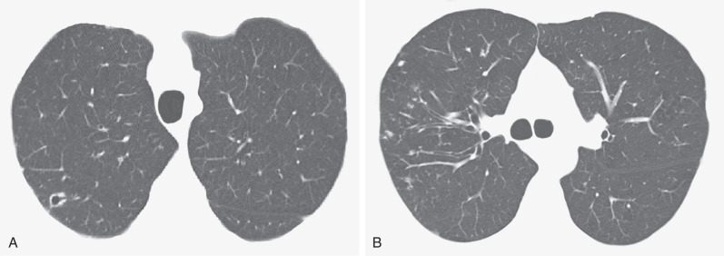 Fig. 11.4, CT findings of Mycobacterium avium-intracellulare infection in the same patient as in Fig. 11.3 . A CT image at the level of the trachea (A) shows a small right upper lobe cavitary lesion. A CT section at the level of the main bronchi (B) demonstrates tree-in-bud and nodular opacities typical of M. avium-intracellulare infection. Also noted is thickening and mild dilation of the right upper lobe bronchi.