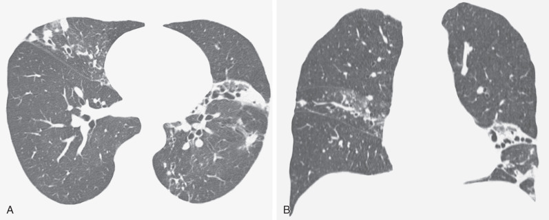 Fig. 11.5, CT findings of Mycobacterium avium-intracellulare infection in a 67-year-old woman with a “Lady Windermere” distribution. A CT image at the level of the right inferior pulmonary vein (A) shows bilateral bronchiectasis. Ground-glass opacities and mild consolidation are present in the right middle lobe, lingula, and left lower lobe. Also evident are small nodular opacities and a few tree-in-bud opacities. A coronal reformatted CT image (B) better demonstrates the predominant distribution of the abnormalities in the right middle lobe and lingula.