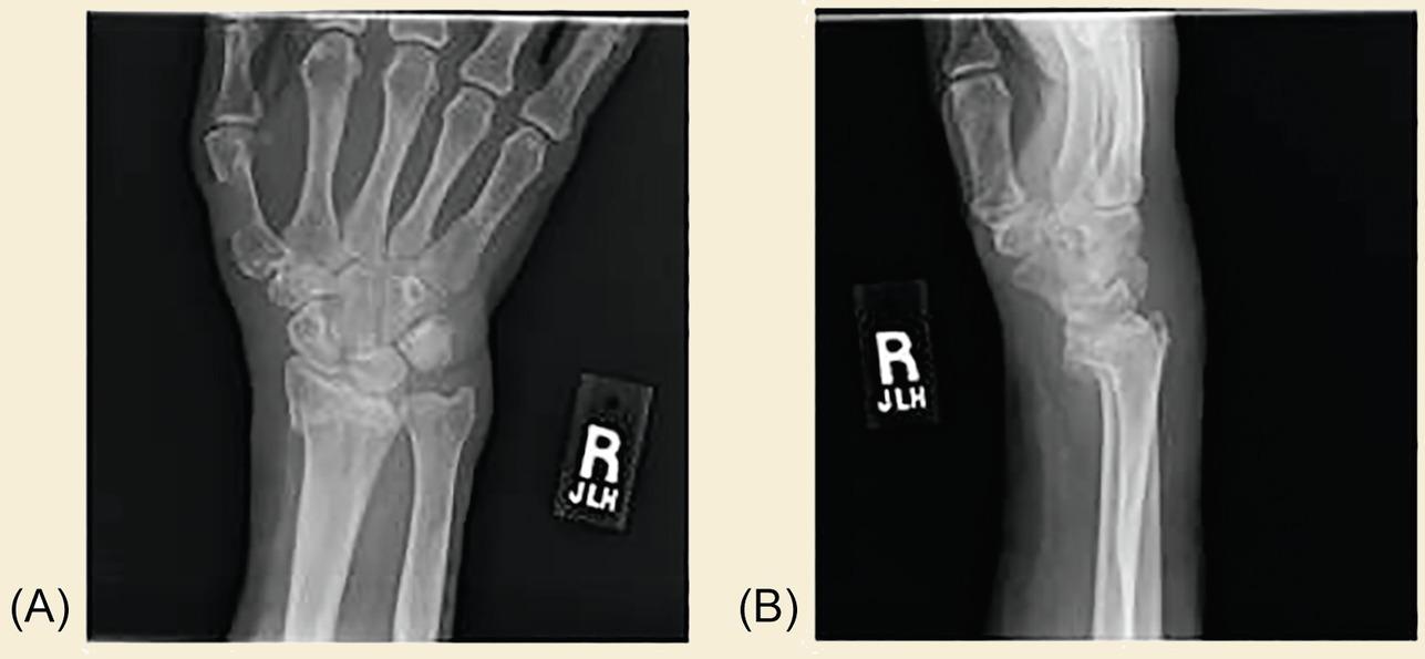 Fig. 1, Injury AP (A) and lateral (B) radiographs of a patient following a distal radius fracture. Subsequent AP (C) and lateral (D) radiographs showing nonunion of the fracture site following attempted closed reduction and casting.