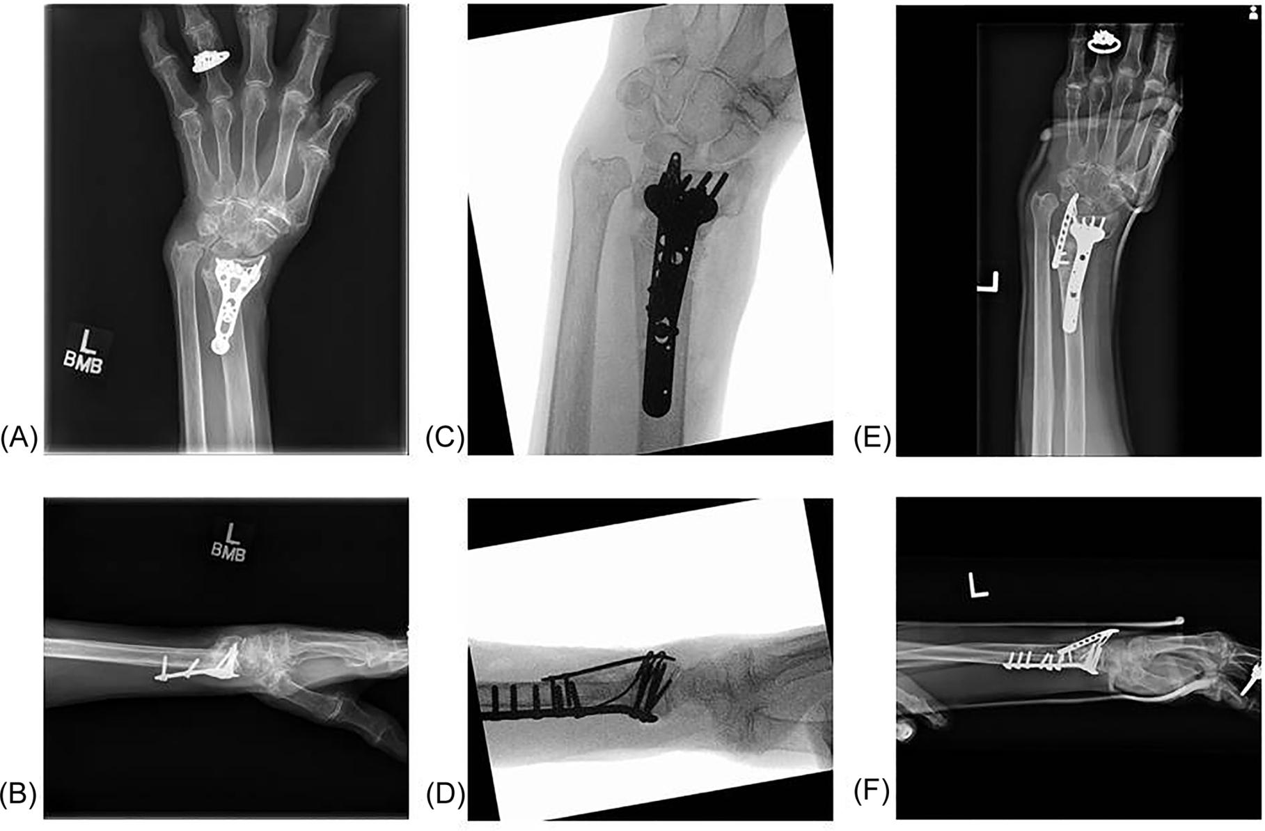 Fig. 2, A commonly encountered clinical scenario in which a patient presents with a malunion (A,B), requiring a revision ORIF with osteotomy for deformity correction (C,D), that subsequently goes on to nonunion (E,F).