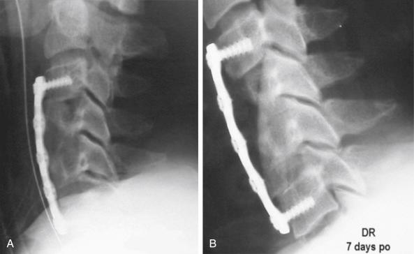 FIGURE 56-2, A, Lateral cervical radiograph 1 day after multilevel corpectomy and anterior cervical instrumentation. The autogenous iliac crest strut graft is well placed. B, Radiograph 1 week postoperatively (po) showing the strut graft kicking anteriorly at the caudal aspect and posteriorly into the spinal canal at the cephalad end.