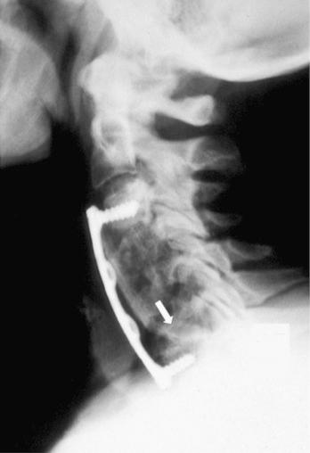 FIGURE 56-3, Lateral radiograph of a three-level corpectomy reconstruction with autogenous iliac crest bone graft and a constrained anterior cervical plate. Radiographs suggest graft fracture. Surgical revision confirmed fracture of the strut graft ( arrow ) and solid fusion of both the cephalad and caudal graft-host junctions.