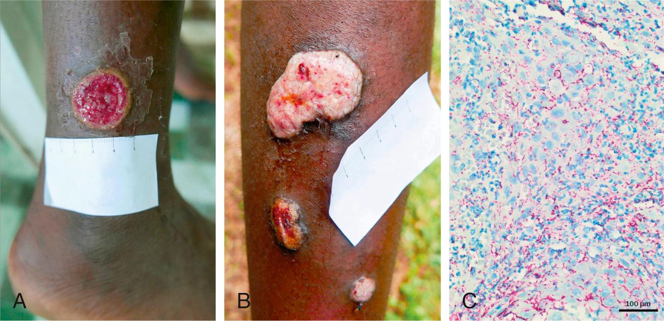 Fig. 246.1, Yaws lesions in a patient with treatment failure associated with macrolide-resistant T p pertenue . A, Primary lesion ( red , moist 2.5 cm ulcer) on the left leg of an 11 yr old patient with yaws observed at the 30-mo survey. Lesional swab PCR was positive for T p pertenue with wild-type 23S rRNA. B, Secondary yaws papillomas (multiple nodules with yellow color granular surface) seen at 36-mo survey. These lesions were PCR positive for T p pertenue with A2059G mutation in 23S rRNA. C, Photomicrograph of skin biopsy of the larger papilloma lesion in panel B with abundant spirochete organisms stained bright red by the Treponema pallidum immunohistochemical stain (×400 magnification). T p pertenue , Treponema pallidum subspecies pertenue.