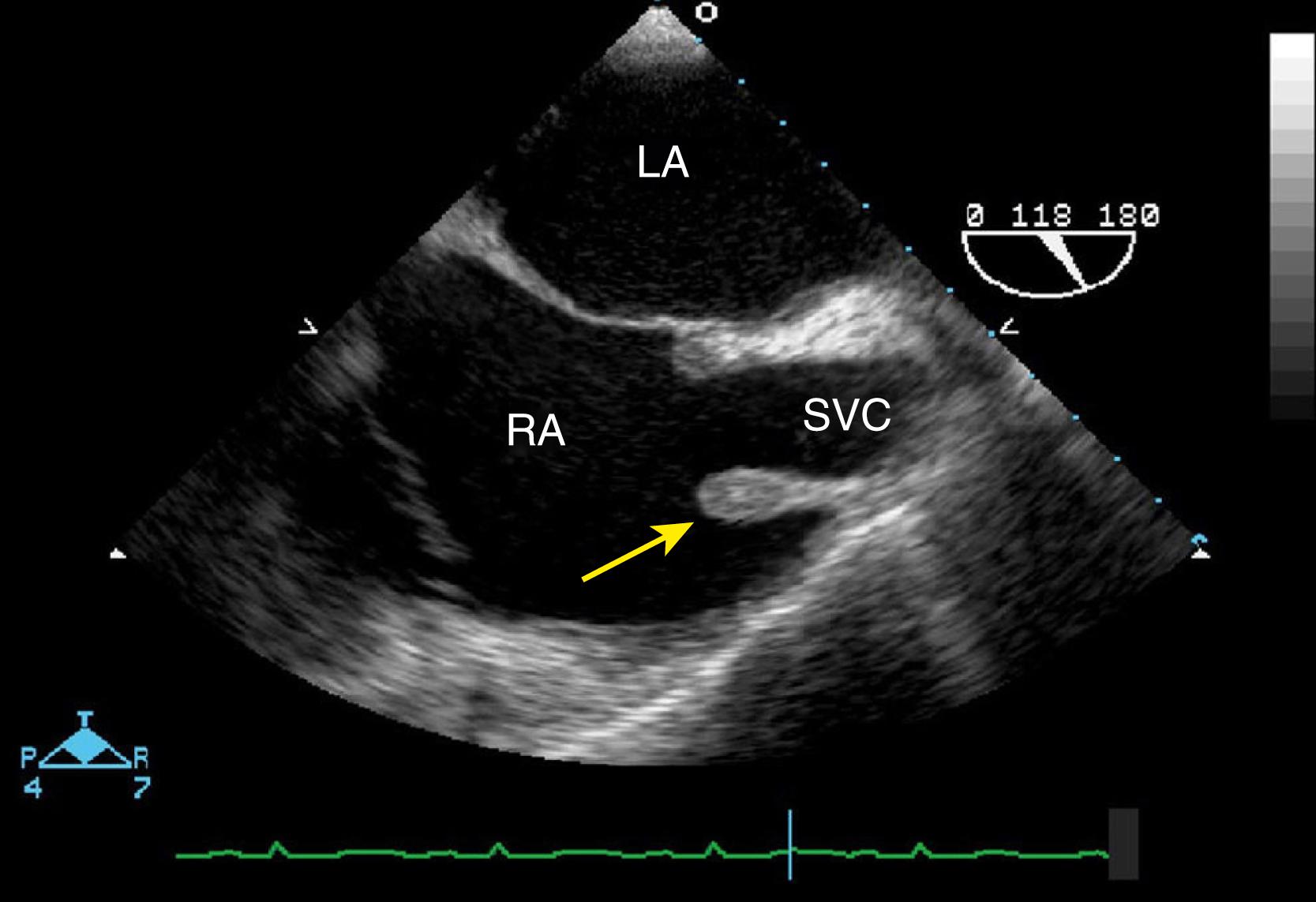 Figure 129.1, Transesophageal echocardiographic bicaval view illustrates a prominent crista terminalis (yellow arrow) . LA, Left atrium; RA, right atrium; SVC, superior vena cava.