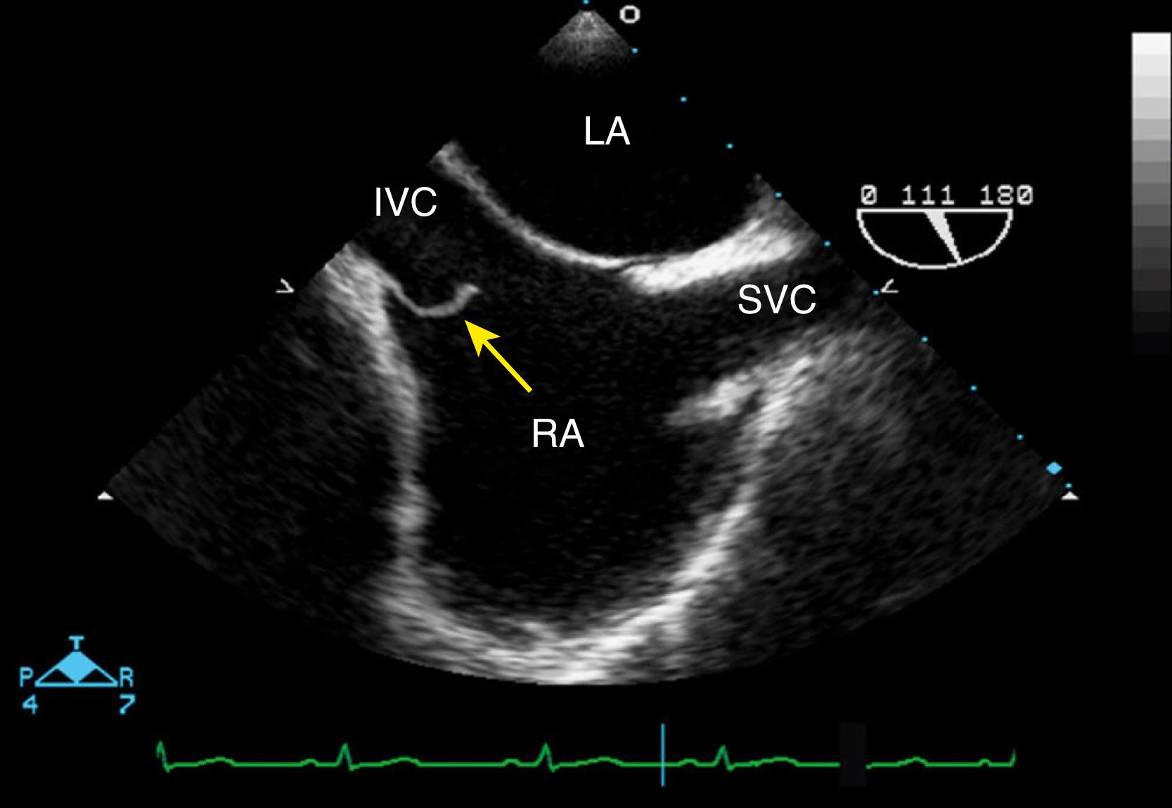 Figure 129.2, Transesophageal echocardiographic bicaval view illustrates a prominent eustachian valve (yellow arrow) in the right atrium (RA) at the inlet of the inferior vena cava (IVC). LA, Left atrium; SVC, superior vena cava.
