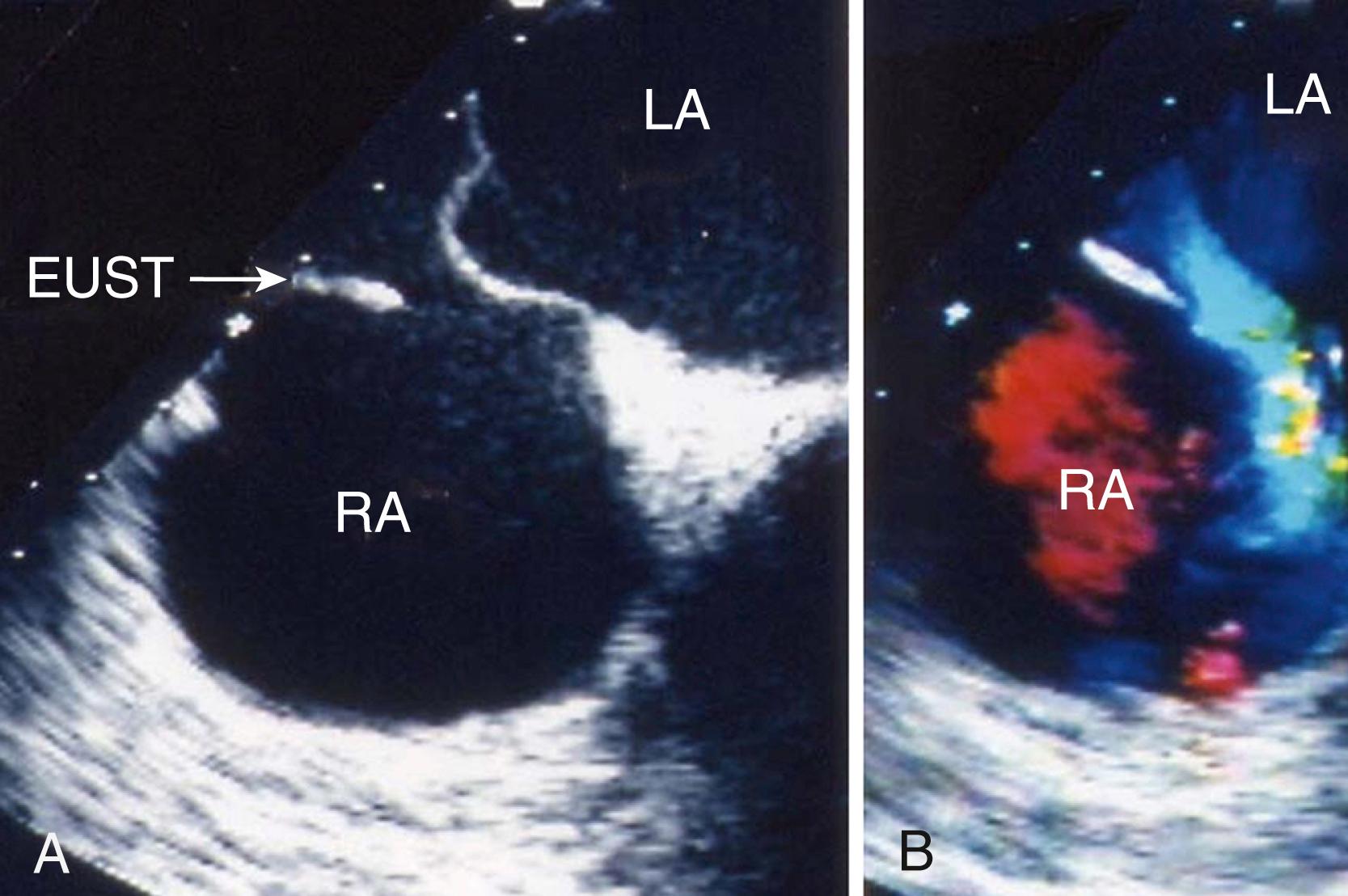 Figure 129.4, Transesophageal echocardiogram illustrating how the presence of a prominent eustachian valve (EUST, A ) can be mistaken for the atrial septum, and therefore normal flow entering from the inferior vena cava (IVC) can mimic an atrial septal defect (ASD). B, The blue jet is caused by blood entering the right atrium (RA) from the IVC; this jet can be misdiagnosed as flow across an ASD. LA, Left atrium.