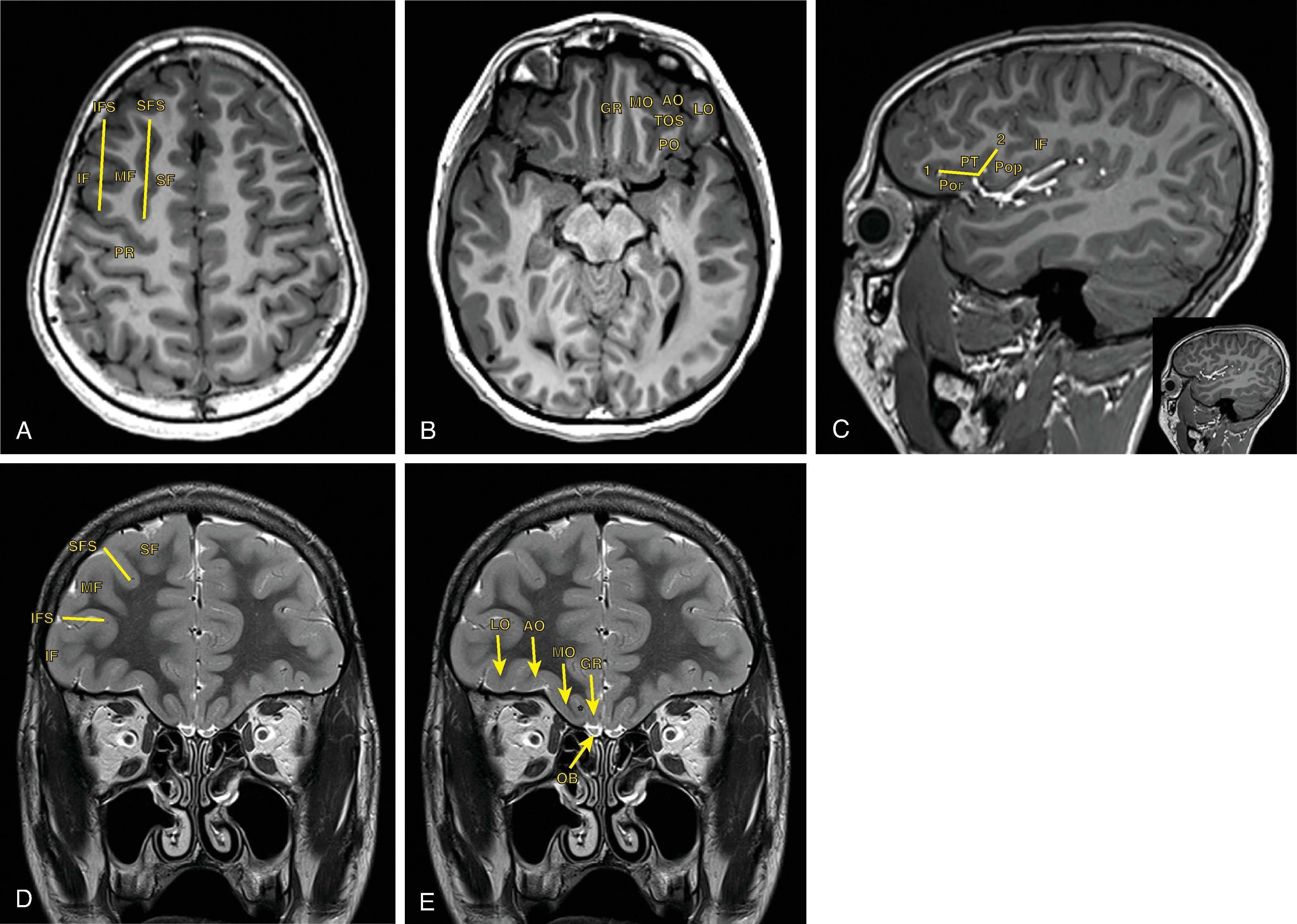 Fig. 21.3, Frontal Lobe Anatomy.