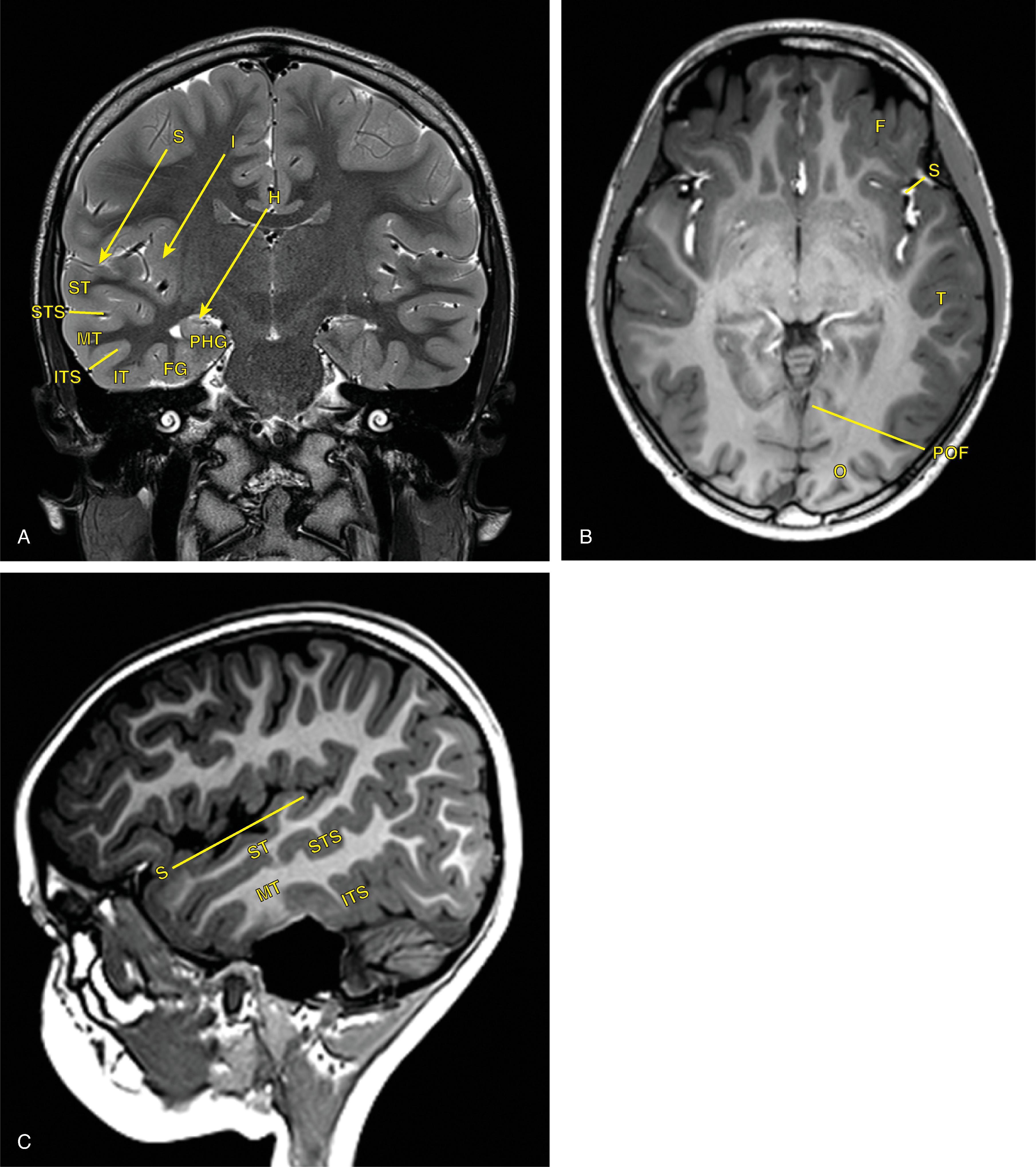 Fig. 21.6, Temporal Lobe Anatomy.