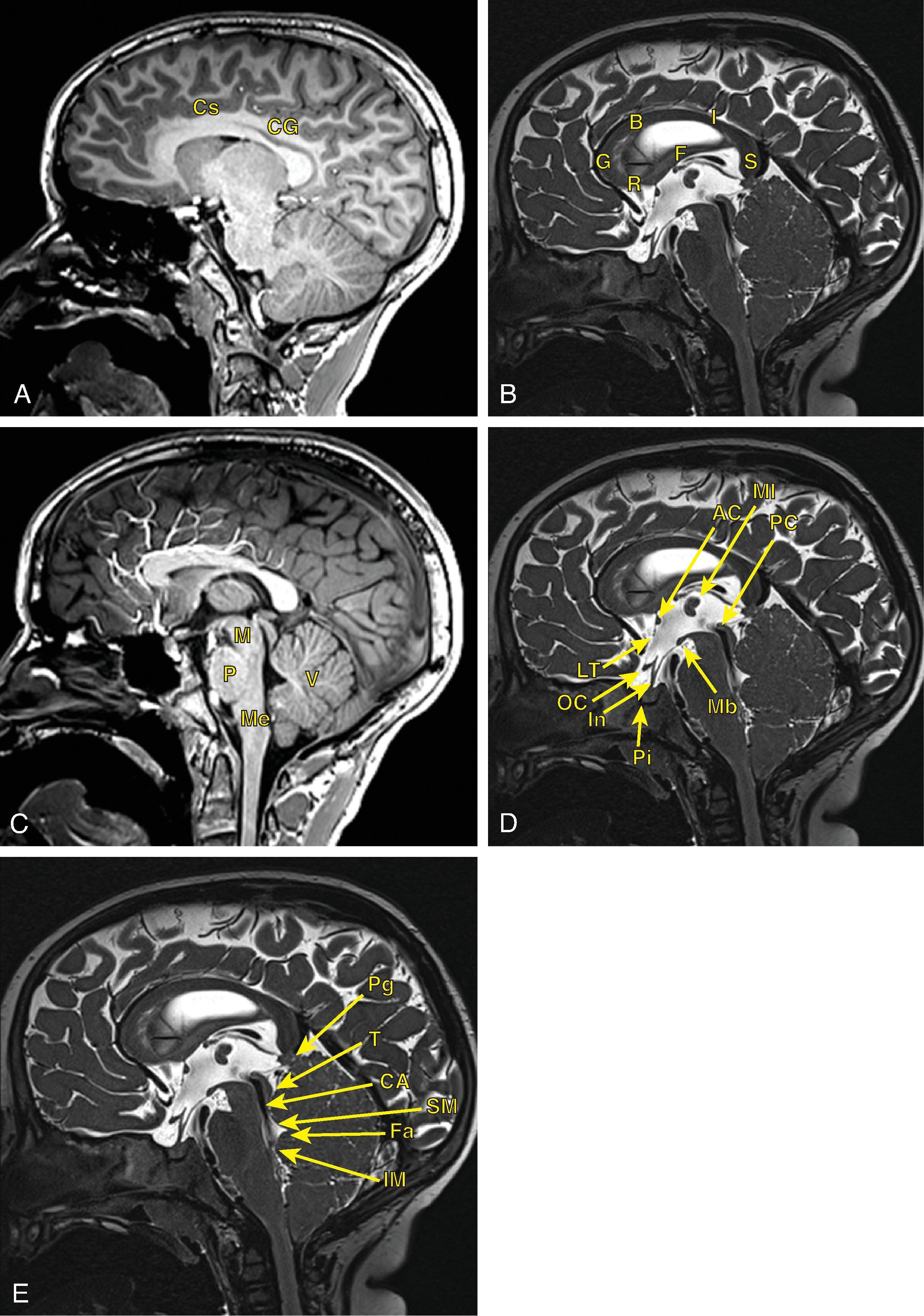 Fig. 21.9, Midline Brain Anatomy.