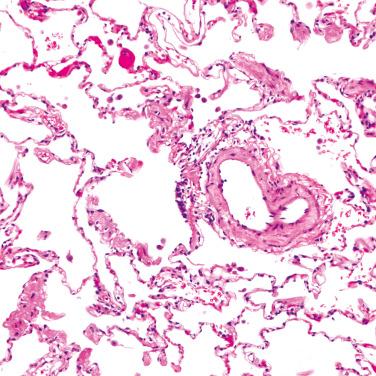 FIG. 1.2, Respiratory bronchiole and peribronchiolar structures. The respiratory bronchiole travels with a small branch of the pulmonary artery. This airway opens into an alveolar duct, as well as individual alveolar sacs. Scattered intraalveolar macrophages are a common finding and may be increased in smokers.